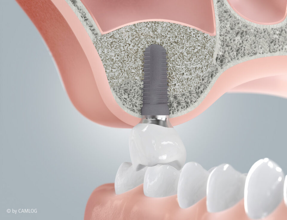 Implantat nach Einheilung des aufgebauten Knochens mit Zahnersatz
