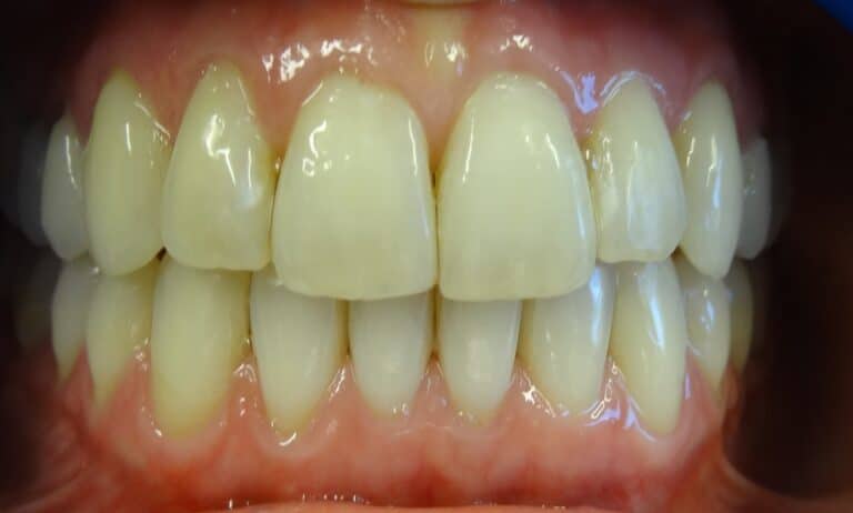 Dr Kinast - unsichtbare Zahnspange