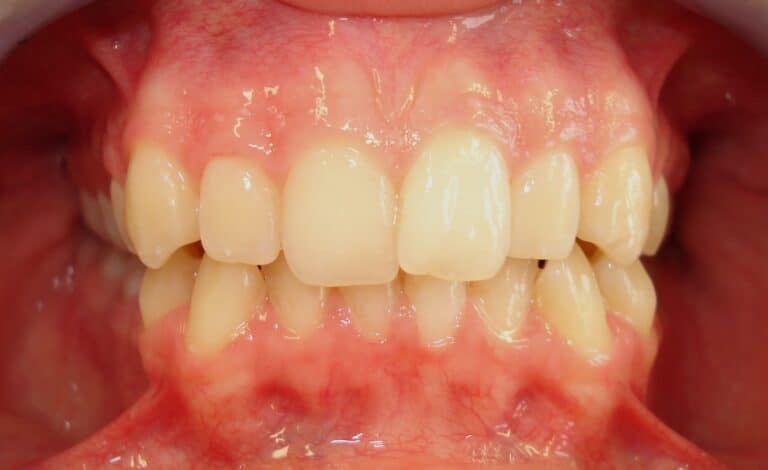 Dr Kinast - unsichtbare Zahnspange