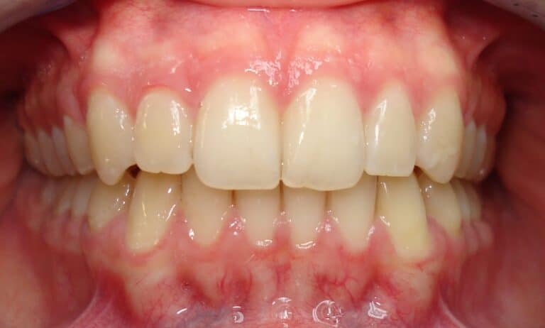 Dr Kinast - unsichtbare Zahnspange